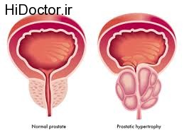 سرطان پروستات چه رابطه ای با سن دارد؟