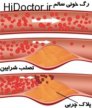 علائم تصلب در شرایین