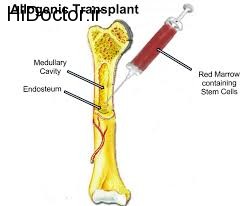 پیوند مغز استخوان با این روش ها