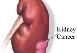 خطر سرطان برای سیستم مجاری ادراری