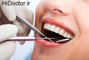 روش های استفاده از دندان مصنوعی