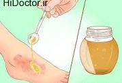 استفاده از عسل برای بهبود زخم ها