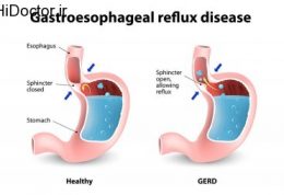 ریفلاکس و راه چاره برای آن