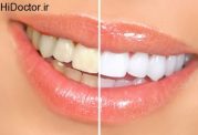 دندان سفید داشتن با این روش ها