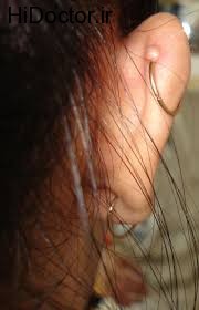 تهدید سلامتی با عفونت ناشی از سوراخ گوش