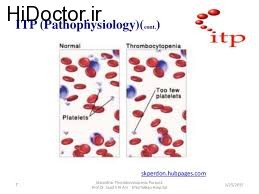 ارتباط کم شدن پلاکت در خون با خون دماغ شدن