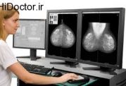 اهمیت انجام ماموگرافی برای سنین بالا