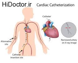 تشخیص بیماری های قلبی با کاتتریزاسیون قلبی