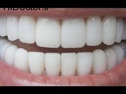 روشی موثر برای سفید کردن دندان