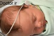 ارتباط تولد زودرس با کم شنوایی نوزادان