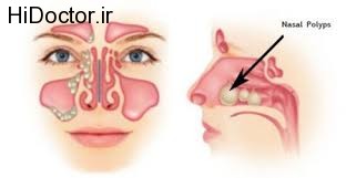 پولیپ داشتن و این عوارض جانبی