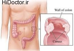 مهار بروز سرطان در جهاز هاضمه