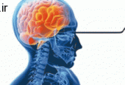 علائم رایج و بارز در مورد سکته مغزی