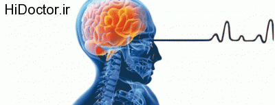 علائم رایج و بارز در مورد سکته مغزی