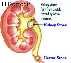 تاثیر دلستر بر سنگ کلیه