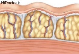 سلولیت و دانسته هایی در این باره