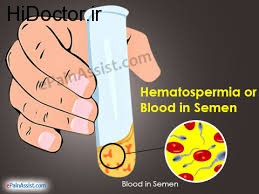 قرمز شدن مایع منی