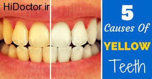 عوامل مختلف زرد شدن دندان