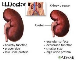 نکاتی پیرامون عارضه های مختلف کلیوی