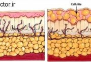 سلولیت و این روش های درمانی