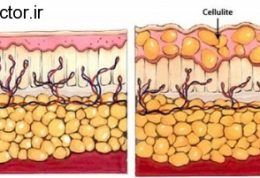 سلولیت و این روش های درمانی