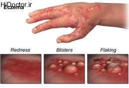 بروز اگزما در ناحیه تناسلی