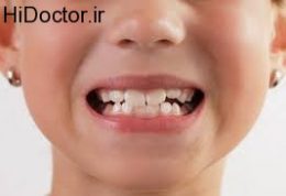 دیر یا زود افتادن دندانهای شیری چه عوارضی دارد؟