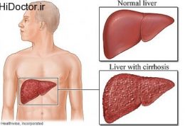دانستنی هایی درباره سیروز کبدی