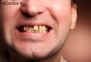 پوسیدگی دندان با این عوامل
