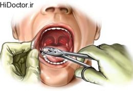دانستنی های مهم پس از کشیدن دندان