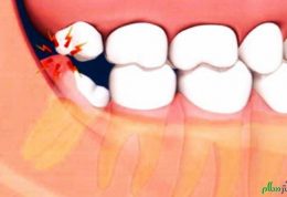 دندان عقل وعوارض جانبی مربوط به آن