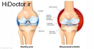 رفع آرتروز با این روش ها