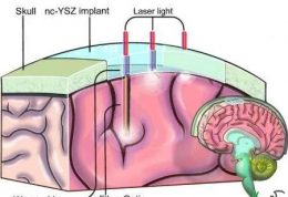 لیزر برای رفع مشکلات مغزی
