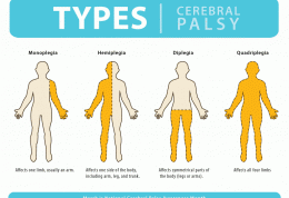 تاکنون در مورد فلج مغزی شنیده اید