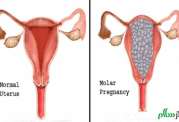 عوارض بارداری مولار