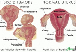 راهنمایی هایی برای مبتلایان به فیبروم در رحم