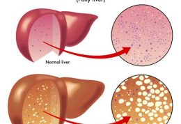 چاقی و چرب شدن کبد