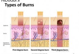 توضیحاتی پیرامون سوختگی پوست