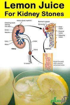 رفع درد ناشی از سنگ کلیه با این روش