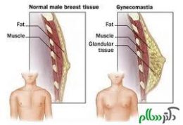 مشکلات ناحیه سینه در مردان