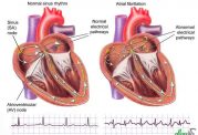آریتمی قلبی و توصیه های پزشکی در مورد آن