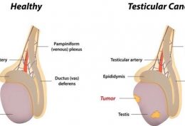 مهار سرطان بیضه با این توصیه ها