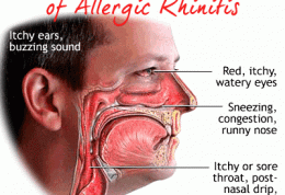 توضیحاتی در مورد ابتلا به رینیت آلرژیک