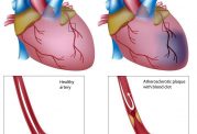 فناوری جدید برای درمان سکته قلبی