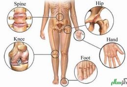 مشکلات مختلف در مفاصل را بشناسید