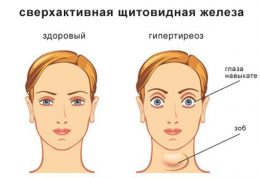 سایز غیرطبیعی چشم ها و این بیماری