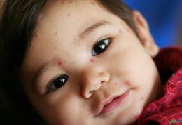 رایج ترین اختلالات پوستی در کودکان