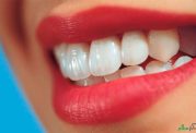 لواشک و لیموترش ، مؤثر در پوسیدگی دندان