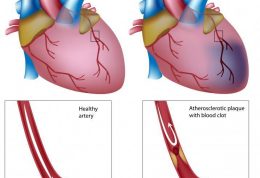 شناخت درمان های تپش قلب