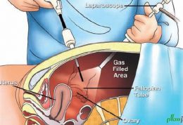 مشکلات استفاده از لاپاراسکوپی